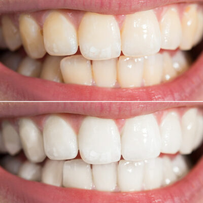 Cost-Effective Home Remedies to Whiten Teeth