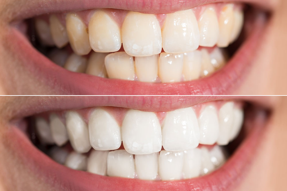 Cost-Effective Home Remedies to Whiten Teeth