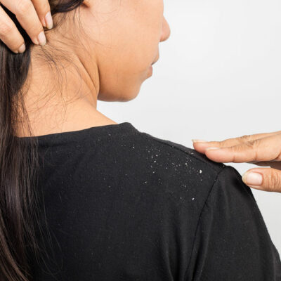 Effective Hair Care Routines to Curb Dandruff